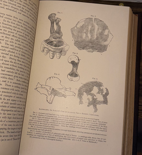 Cyclopædia of the Diseases of Children – Vol. II (John M. Keating, Antique Medic