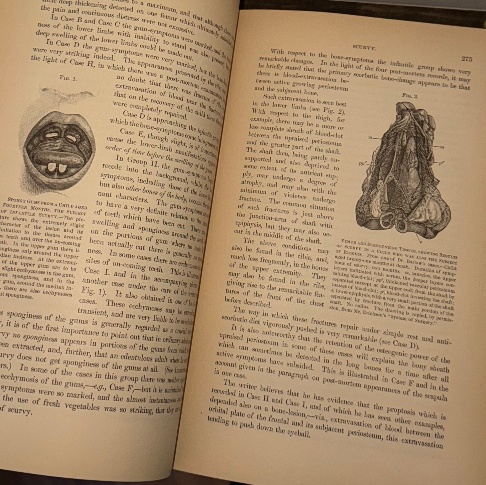 Cyclopædia of the Diseases of Children – Vol. II (John M. Keating, Antique Medic